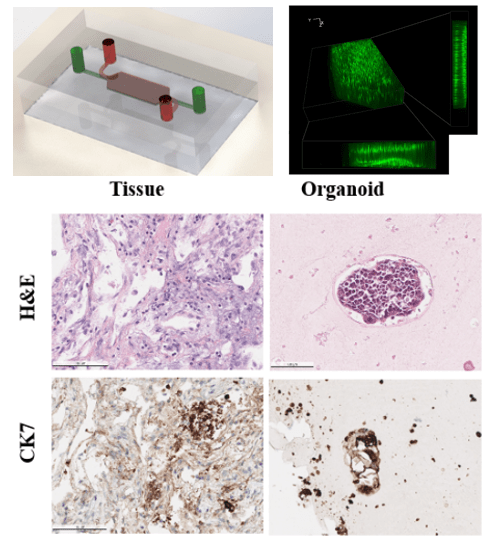 Patient-Derived Lung Adenocarcinoma Organoid in Fibrin Gel Towards 3D High Throughput Culture and Therapeutic Screening